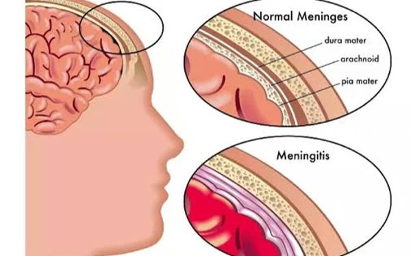 Thumbnail Berita - Ini Beberapa Langkah Mencegah Meningitis pada Anak