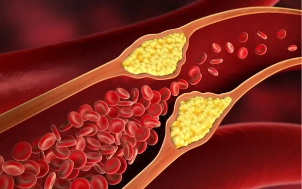 Thumbnail Berita - Awas, Ini Gejala Kolesterol Tinggi yang Perlu Diantisipasi