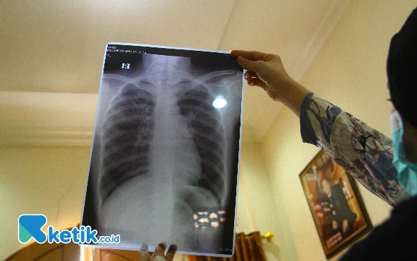 Thumbnail Arlin Nursyarifah melihat hasil X-ray dari Rumah Sakit yang menyatakan terkena Infeksi Saluran Pernapasan Akut (ISPA), Rabu (18/10/2023). (Foto: Wahyu R/Ketik.co.id)